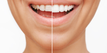 무삭제라미네이트후기 치아삭제없는 블랙필름 관련 이미지 1