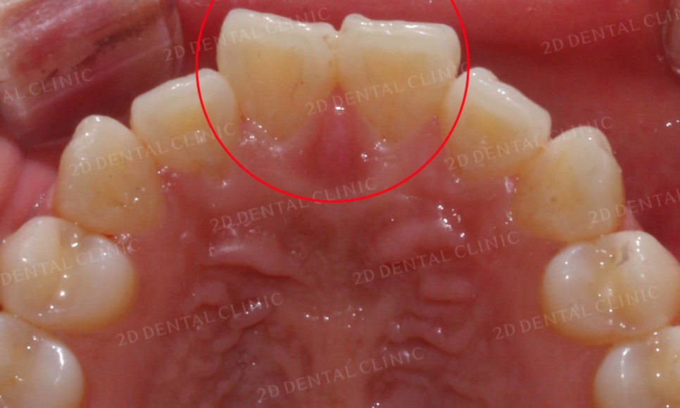 [2D교정] 나비치아, 앞니교정 설측교정으로 빠르게 하는 방법! by.2D치과(투디치과) 관련 이미지 6