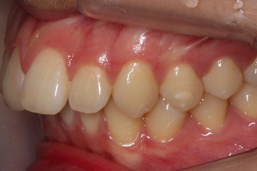 입돌출 데이몬교정 Case1 관련 이미지 5