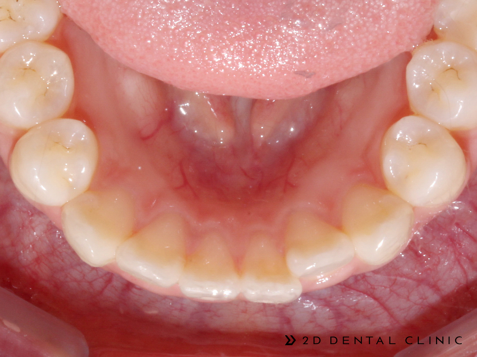 케이스로 확인하는 토끼이빨, 교정전문 2D치과 관련 이미지 11