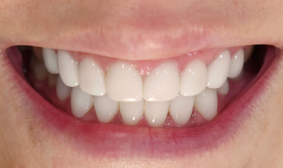 무삭제 라미네이트잘하는곳 잘 찾는 법! 관련 이미지 12