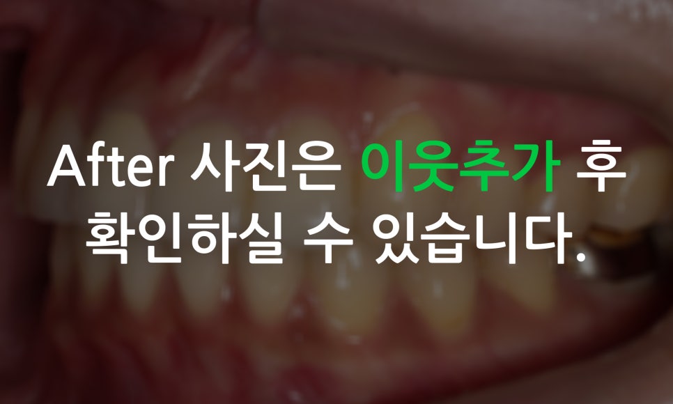 토끼앞니교정, PFM크라운 재보철을 동시에 치료하는 방법? 관련 이미지 11