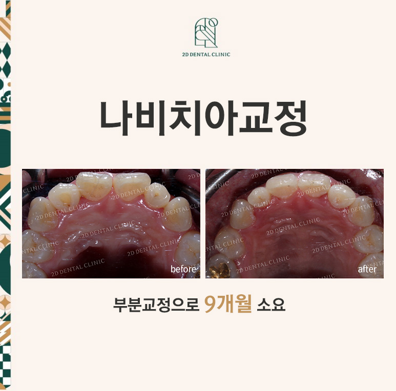나비치아교정, 부분교정으로 나비치아 탈출하기! by.투디치과(2D치과) 관련 이미지 1