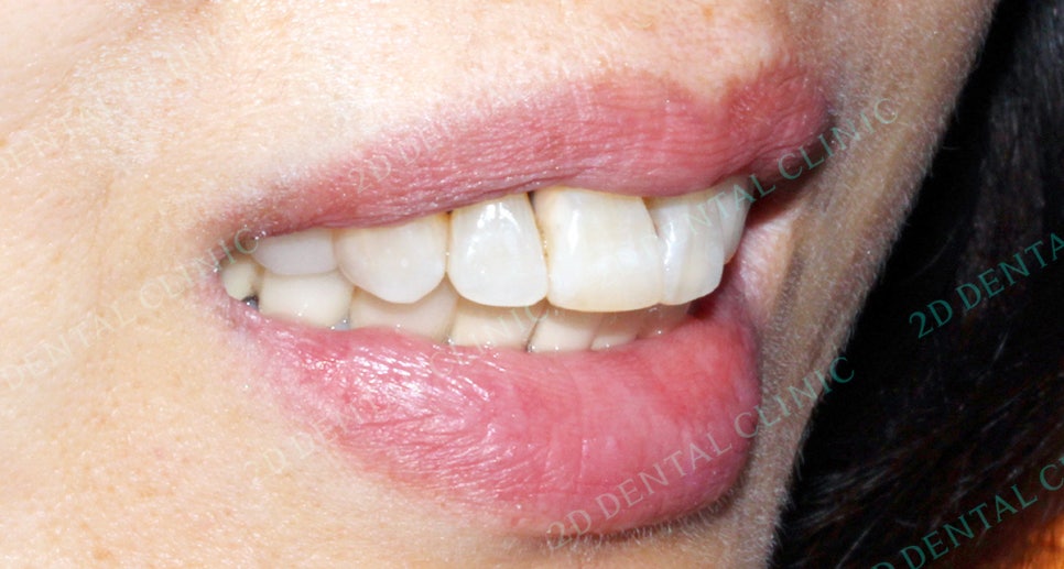 2D치과(투디치과) 교정일기 ㅣ 잇몸질환 예방되는 치아교정(feat.어머님교정) 관련 이미지 8