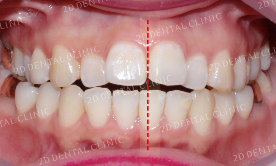 [앞니교정] 부정교합 교정, 앞니교정으로 부정교합 교정하는 방법! by. 투디치과(2D치과) 관련 이미지 5