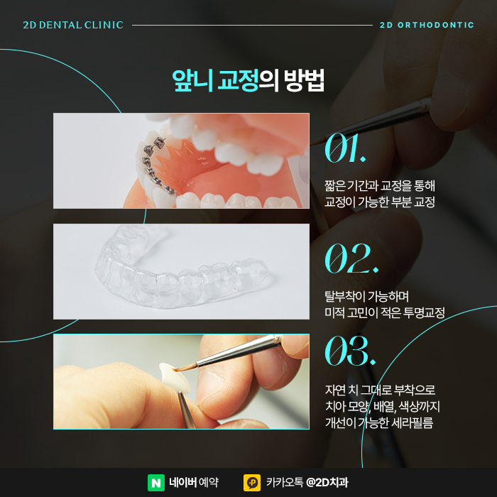 튀어나온 토끼이빨, 치아교정 방법은 신논현역 2D부분교정 관련 이미지 2