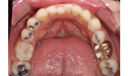 앞니틀어짐 부분교정 완성 후기 관련 이미지 7