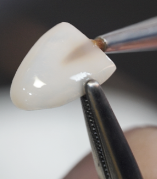 거미스마일 잇몸성형 강남라미네이트 2D치과 관련 이미지 7