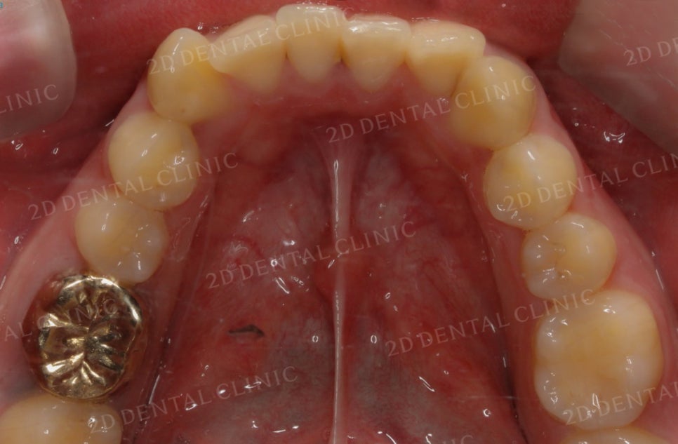 [앞니교정] 토끼앞니교정, 클리피씨 교정으로 완벽하게! by.투디치과(2D치과) 관련 이미지 18