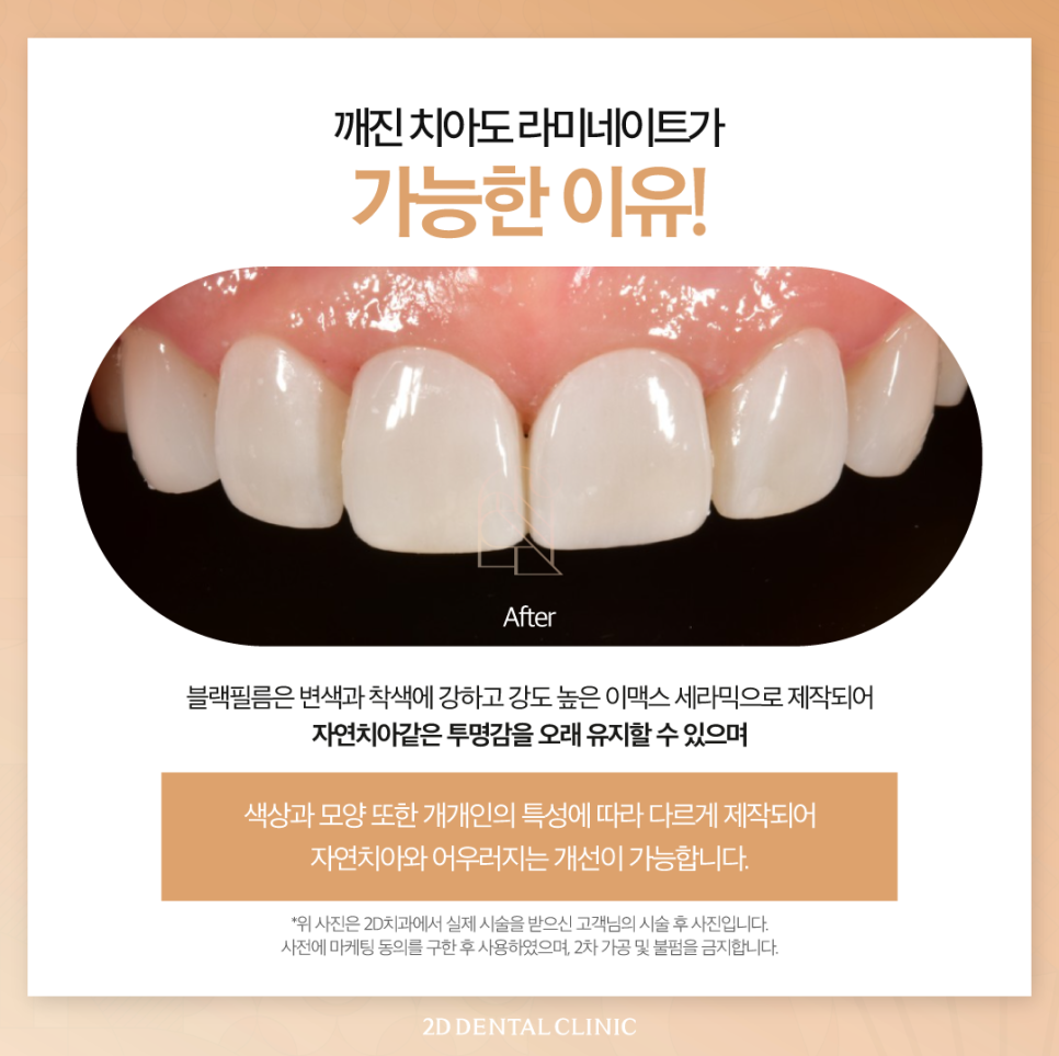 대구무삭제라미네이트 앞니깨짐비용보다 이것에 집중해 주세요! 관련 이미지 5