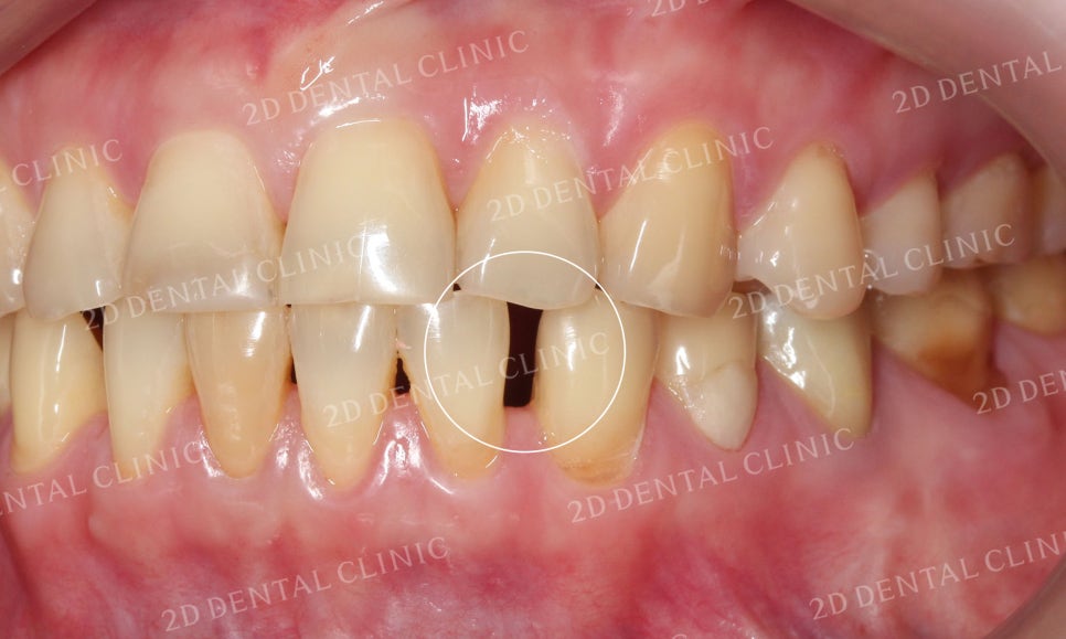 누렇고 손상된 치아를 밝고 가지런하게! by. 투디치과(2D치과)_블링스 시술후기 관련 이미지 9