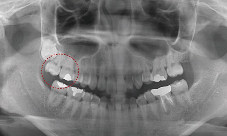 우디의 교정일기ㅣ토끼이빨 치아교정(ft.클리피씨 전체교정) 관련 이미지 5