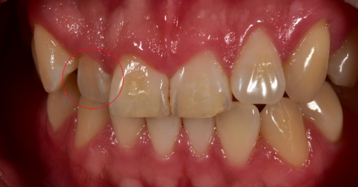 치아성형 잇몸성형 치아삭제 없는 무삭제라미네이트 블랙필름 관련 이미지 9