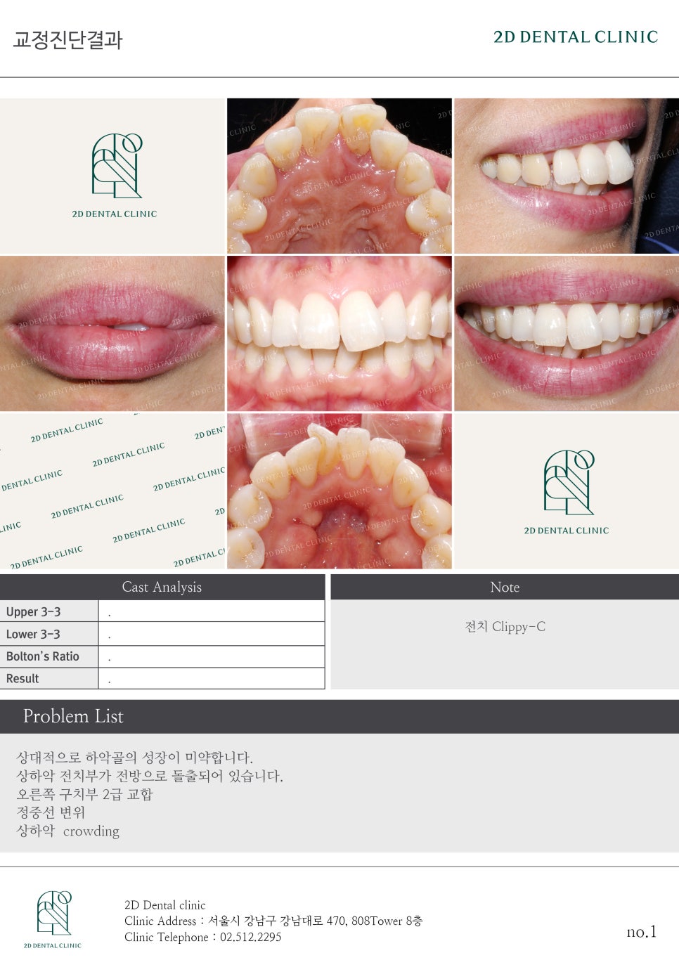 [앞니교정] 돌출앞니교정, 토끼앞니를 클리피씨교정으로 완성하기! by. 투디치과(2D치과) 관련 이미지 8