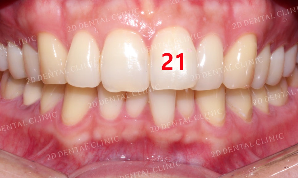 틀어진 앞니를 전체 교정으로 바르게! by.투디치과(2D치과) 관련 이미지 4