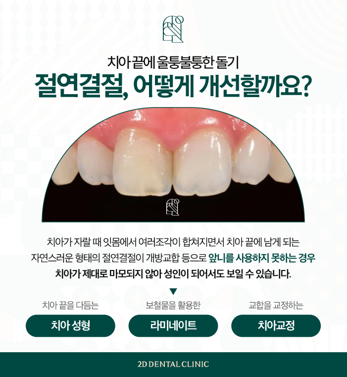 울퉁불퉁한 치아라인을 매끄럽게 무삭제라미네이트 블랙필름 관련 이미지 3