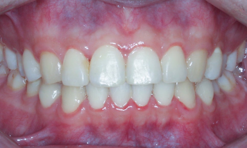 나비치아교정! 15개월만에 빠른 교정 by.투디치과(2D치과) 관련 이미지 12