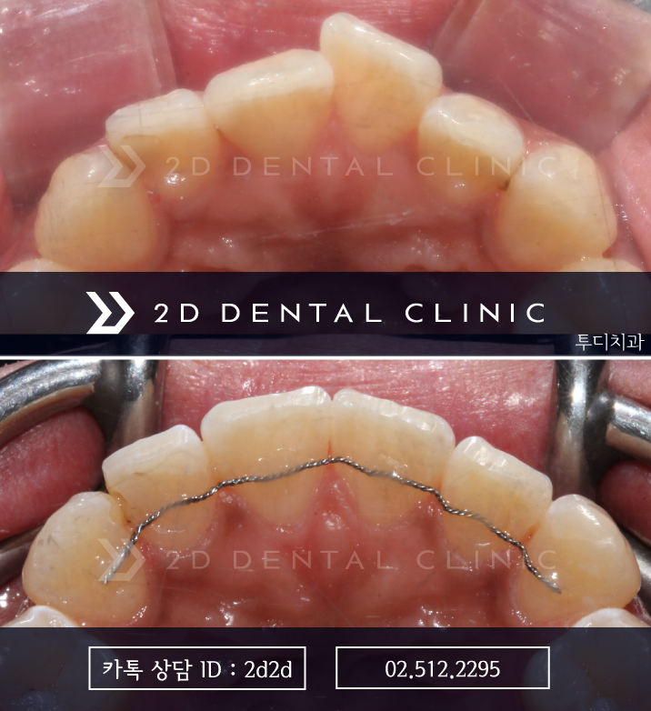 앞니 부분교정, 나의 경우에도 가능할까? 전후 사진 비교 관련 이미지 6