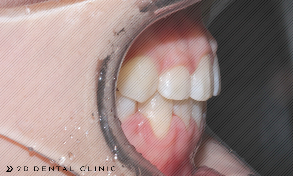 절단교합 교정 케이스 전후비교, 교정전문 2D치과 관련 이미지 13