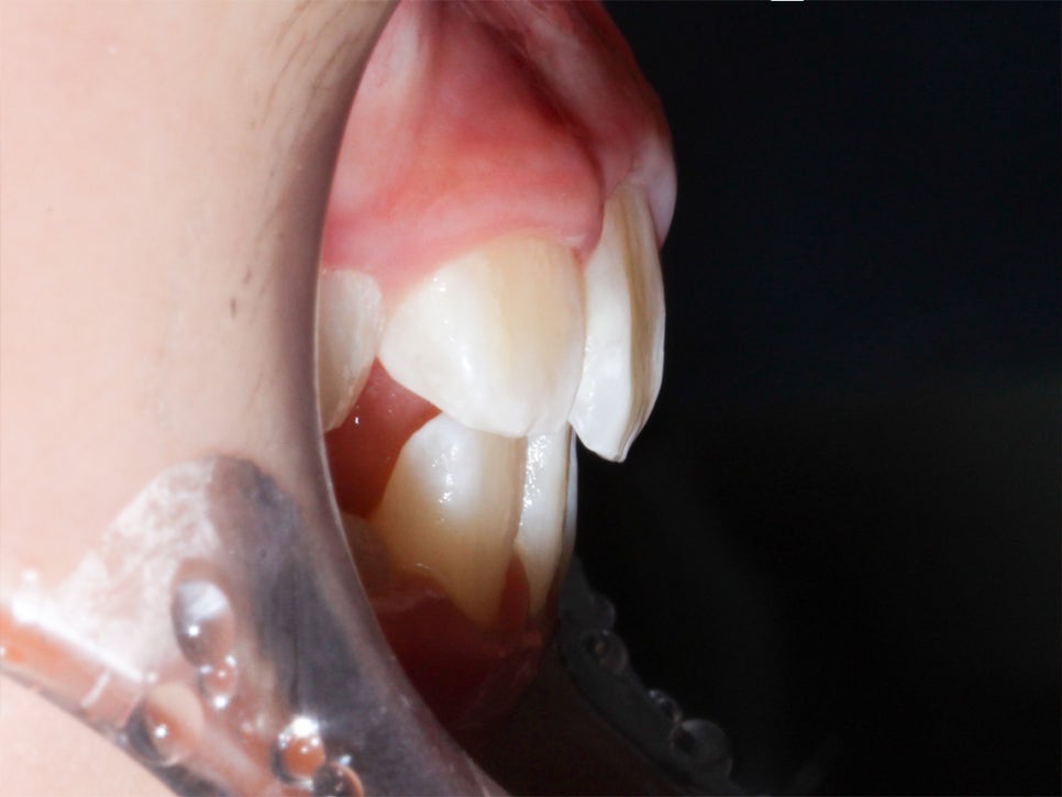 어린이 반대교합 덧니 교정으로 교정 끝! by. 투디치과(2D치과) 관련 이미지 11