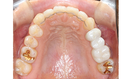앞니틀어짐 부분교정 완성 후기 관련 이미지 12