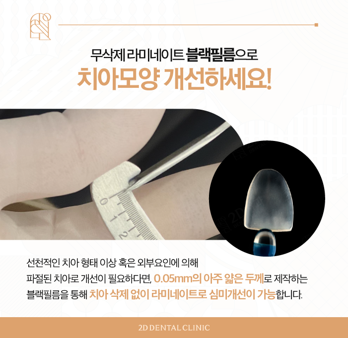 인위적인 치아 개선은 NO! 블랙필름 무삭제라미네이트 관련 이미지 4