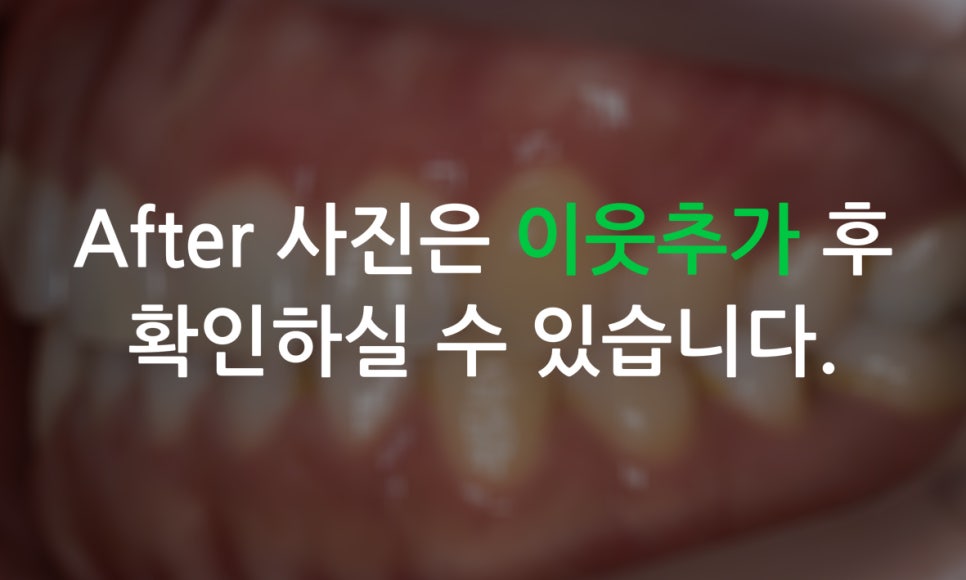 덧니교정 2D교정 (부분교정) 후기 관련 이미지 10