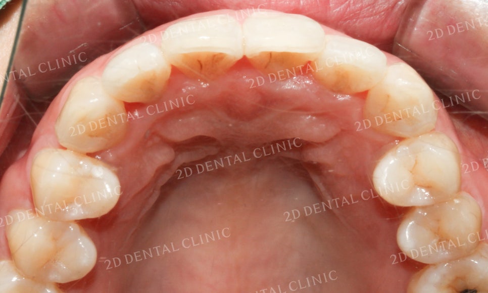 [앞니교정] 돌출앞니교정, 토끼앞니를 클리피씨교정으로 완성하기! by. 투디치과(2D치과) 관련 이미지 12