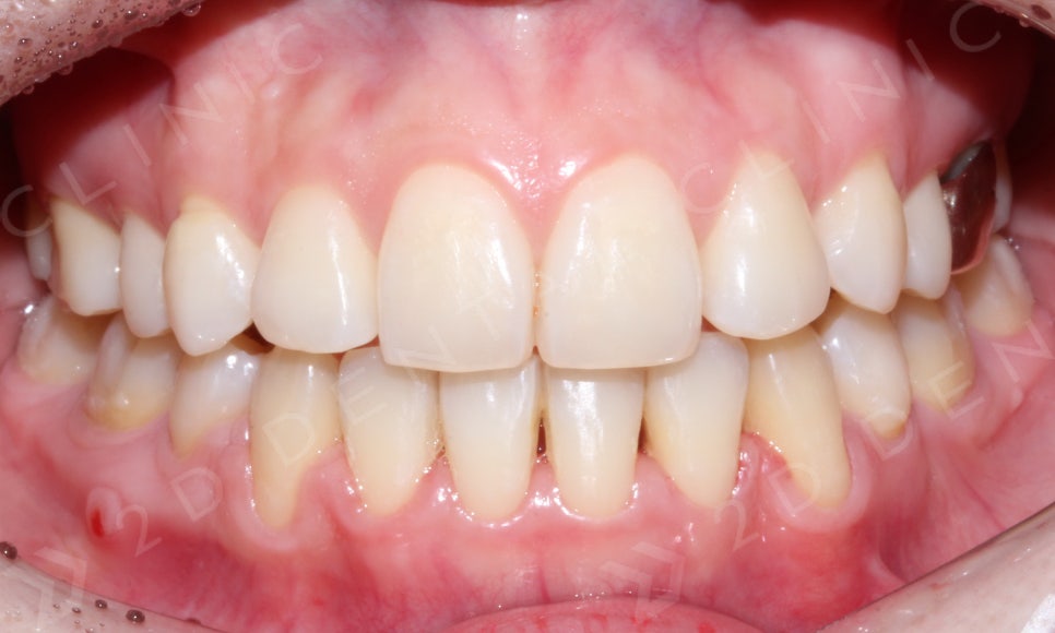 덧니만 부분교정으로 교정 할 수 있나요? 관련 이미지 10