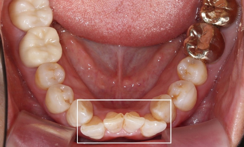 2D치과 2D부분교정으로 아랫니만 빠르게! 관련 이미지 1