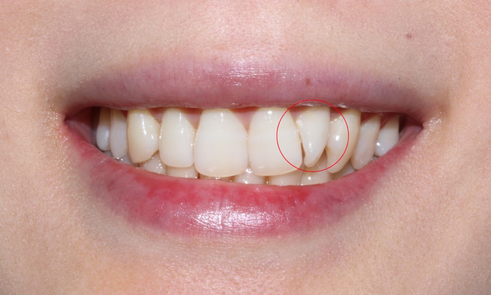 앞니틀어짐 2D교정으로 한번에 끝내는 방법! 관련 이미지 1
