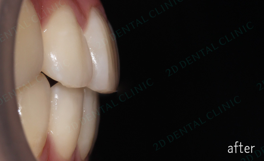 우디의 교정일기ㅣ덧니 치아교정 후기 (feat.부정교합) 관련 이미지 11