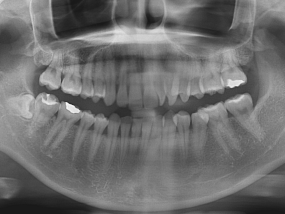 덧니치아 앞니교정 4개월 교정 완료! by. 투디치과(2D치과) 관련 이미지 7