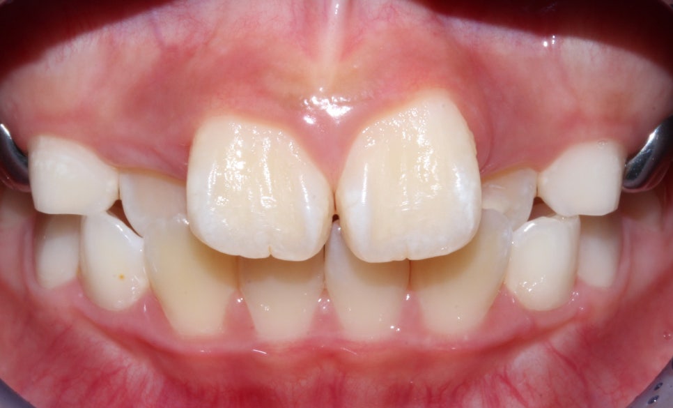 어린이 반대교합 덧니 교정으로 교정 끝! by. 투디치과(2D치과) 관련 이미지 6