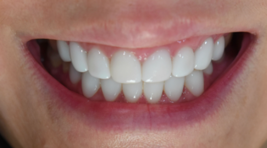 앞니라미네이트 치아삭제없는 무삭제라미네이트 블랙필름 관련 이미지 8