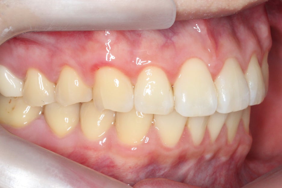 논현동치과 윗니부분교정 후기 관련 이미지 10