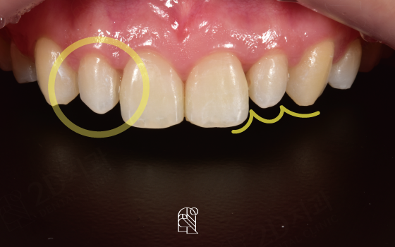 앞니왜소치 치아깨짐 무삭제라미네이트 블랙필름 관련 이미지 2