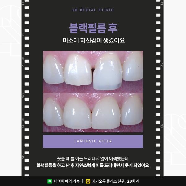 앞니 라미네이트 블랙필름의 효과성 A to Z 관련 이미지 3