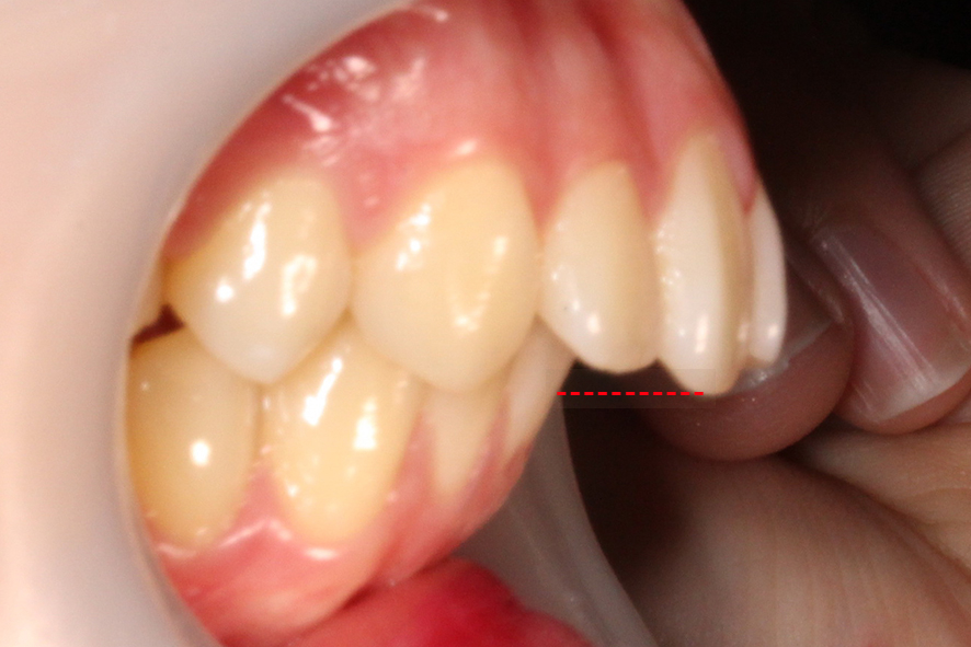 입돌출 데이몬교정 Case1 관련 이미지 3