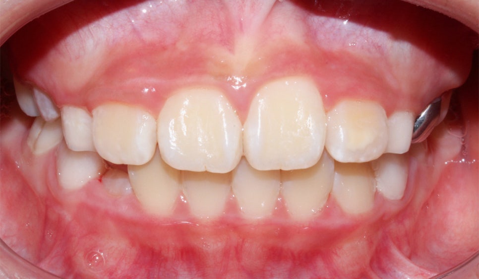 어린이 반대교합 덧니 교정으로 교정 끝! by. 투디치과(2D치과) 관련 이미지 14