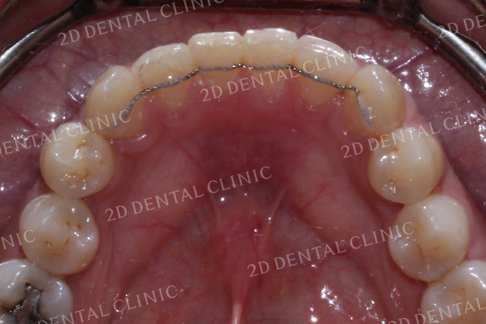 반대교합으로 물리는 치아를 바른 교합으로 교정하기! by.투디치과(2D치과) 관련 이미지 17