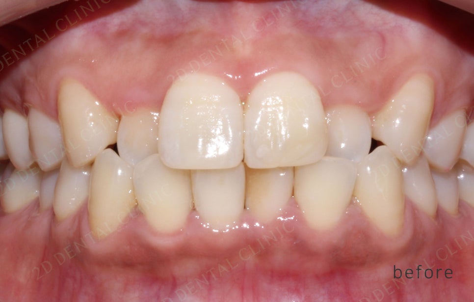 2D치과(투디치과) 교정일기ㅣ앞니덧니,반대교합 치아교정 완료!(ft.투디교정 전체교정) 관련 이미지 11