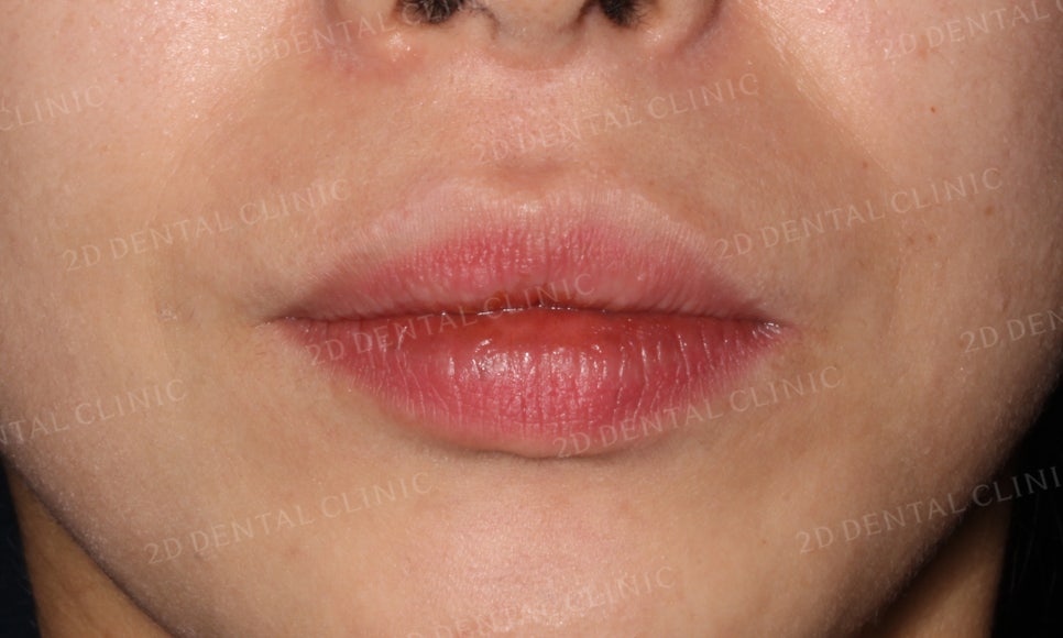 [부분교정] 틀어진 앞니, 부분교정으로 앞니교정하기! by.투디치과(2D치과) 관련 이미지 11