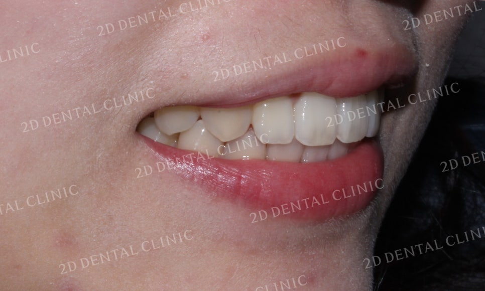 [앞니교정]토끼앞니교정, 부분교정으로 토끼이빨 탈출하기! by.투디치과(2D치과) 관련 이미지 10