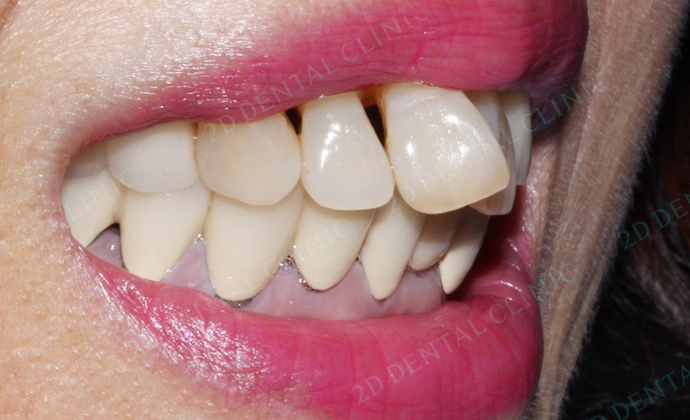 2D치과(투디치과) 교정일기 ㅣ 잇몸질환 예방되는 치아교정(feat.어머님교정) 관련 이미지 5