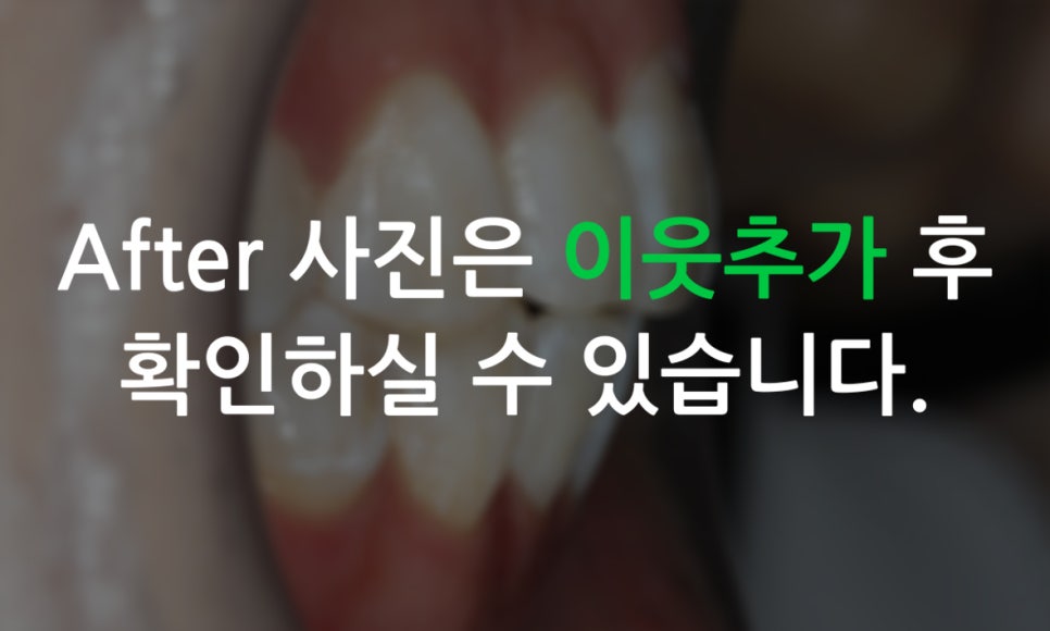 앞니돌출 급속교정 Case feat. 2D교정 관련 이미지 13