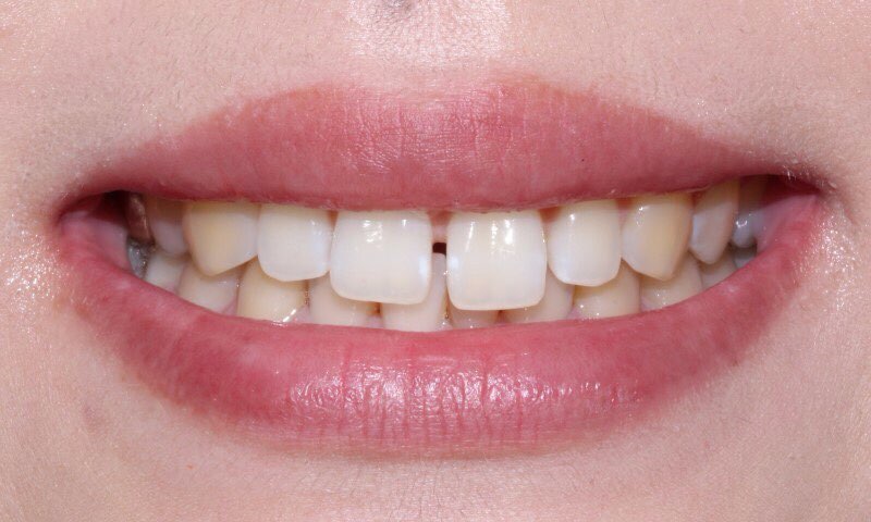 앞니 부분교정, 나의 경우에도 가능할까? 전후 사진 비교 관련 이미지 1