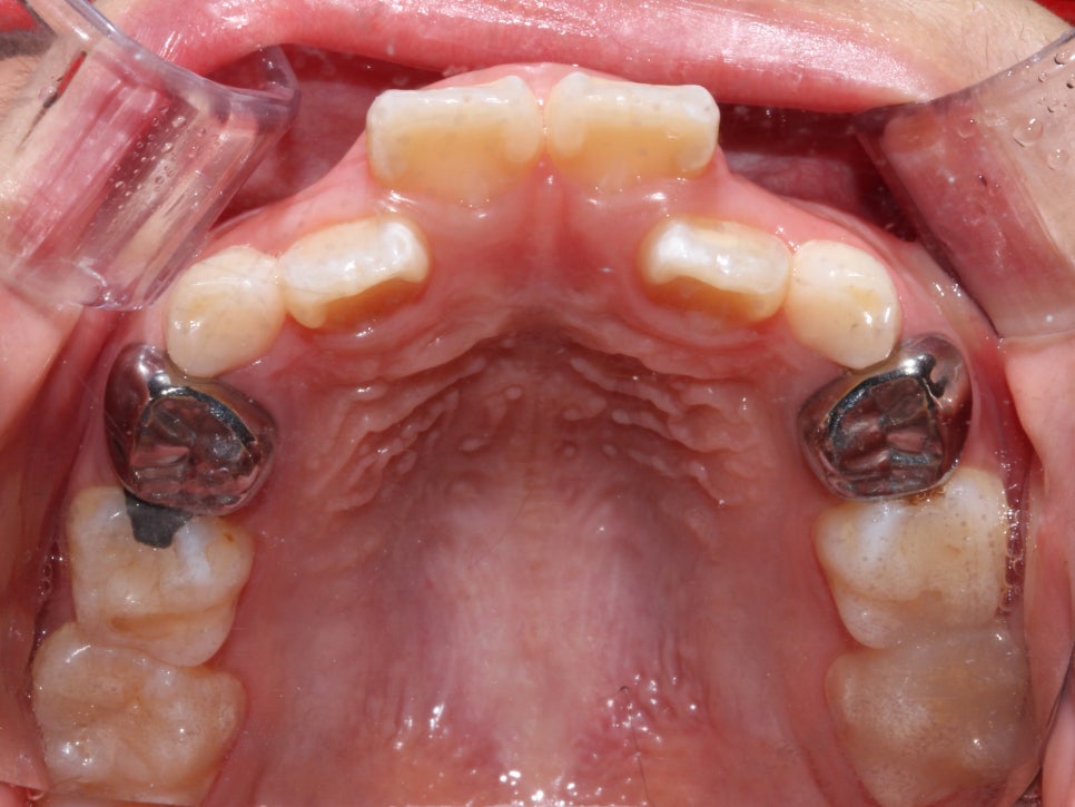 어린이 반대교합 덧니 교정으로 교정 끝! by. 투디치과(2D치과) 관련 이미지 8