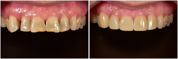 앞니라미네이트 잘하는 곳 : 2D치과 관련 이미지 7