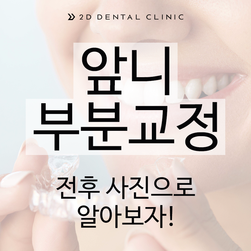 앞니 부분교정, 전후 사진으로 알아보자! 강남 2D치과 관련 이미지 1